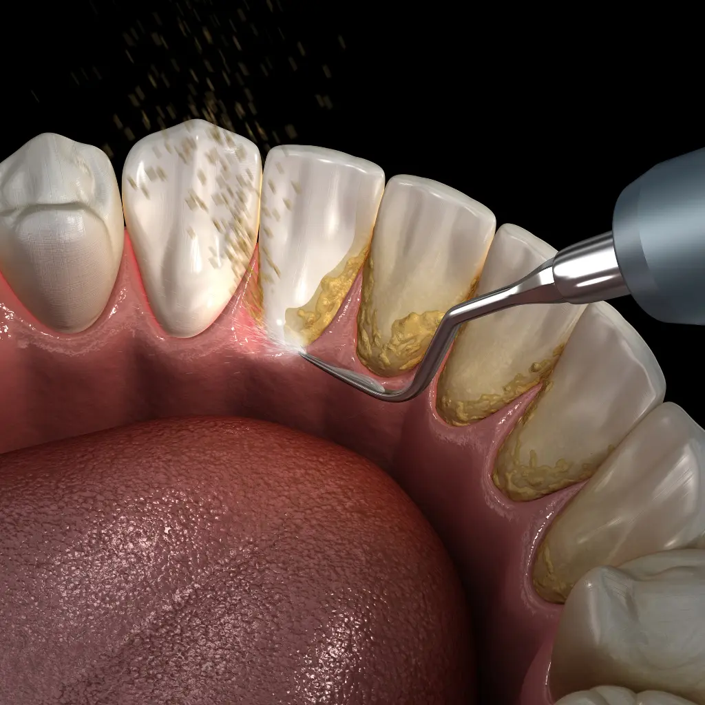 Teeth Cleaning in Stockbridge GA